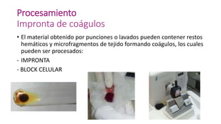 Procesamiento
Impronta de coágulos
• El material obtenido por punciones o lavados pueden contener restos
hemáticos y microfragmentos de tejido formando coágulos, los cuales
pueden ser procesados:
- IMPRONTA
- BLOCK CELULAR
 