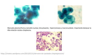 Marcado pleomorfismo y tamaño nuclear, binucleación, hipercromasia y macronucléolo. Importante destacar la
Alta relación núcleo citoplasma.
https://citotecs.wordpress.com/2013/07/11/derrame-de-cavidades-citopreparacion/
 