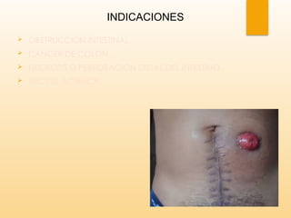 MANEJO DE PACIENTE CON COLOSTOMIIA MATERIAL DE SISTEMA DIGESTIVO | PPTX