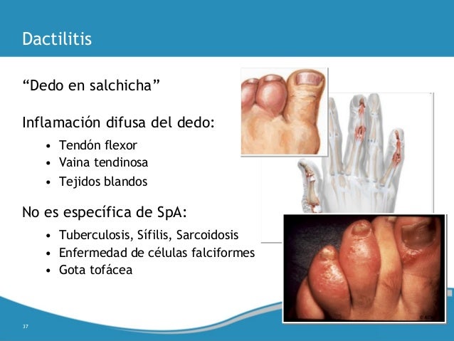 La bilirrubina es subida atopichesky la dermatitis a