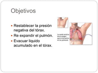 Objetivos
 Restablecer la presión
negativa del tórax.
 Re expandir el pulmón.
 Evacuar liquido
acumulado en el tórax.
 