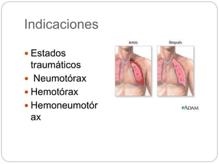 Indicaciones
 Estados
traumáticos
 Neumotórax
 Hemotórax
 Hemoneumotór
ax
 