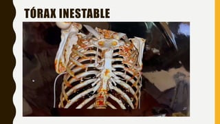 Manejo de trauma de tórax actualizado y caso | PPTX