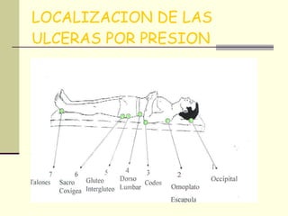 LOCALIZACION DE LAS ULCERAS POR PRESION 
