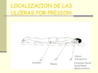 LOCALIZACION DE LAS ULCERAS POR PRESION 