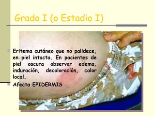 Grado I (o Estadio I) Eritema cutáneo que no palidece, en piel intacta. En pacientes de piel oscura observar edema, induración, decoloración, calor local. Afecta EPIDERMIS 