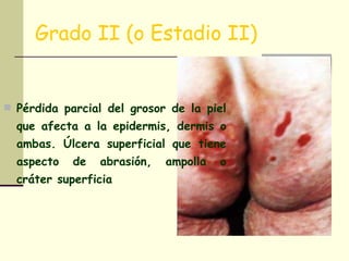 Grado II (o Estadio II) Pérdida parcial del grosor de la piel que afecta a la epidermis, dermis o ambas. Úlcera superficial que tiene aspecto de abrasión, ampolla o cráter superficia 