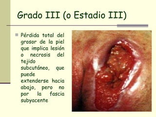 Grado III (o Estadio III) Pérdida total del grosor de la piel que implica lesión o necrosis del tejido subcutáneo, que puede extenderse hacia abajo, pero no por la fascia subyacente 