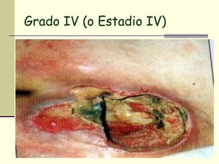 Grado IV (o Estadio IV) 