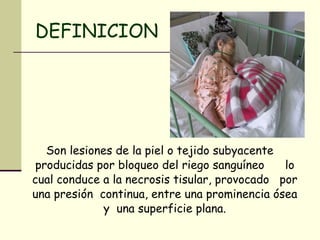 DEFINICION Son lesiones de la piel o tejido subyacente producidas por bloqueo del riego sanguíneo  lo cual conduce a la necrosis tisular, provocado  por una presión  continua, entre una prominencia ósea y  una superficie plana. 