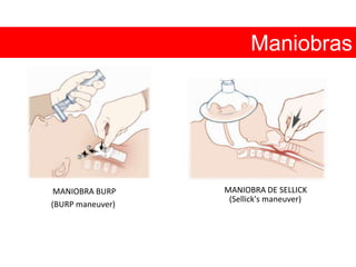 Maniobras MANIOBRA DE SELLICKMANIOBRA BURP(Sellick'smaneuver)(BURP maneuver)