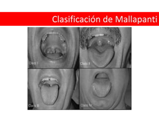 Distancia esternomentoniana