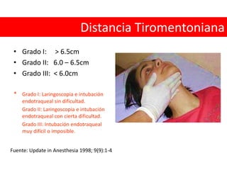 Protrusión MandibularVía aérea dificultosa LMIRAR EL CUELLO, ALTERACIONES ANATOMICAS, BARBA-BIGOTEEEVALUAR EL 3-3-2:  3 DEDOS DE APERTURA BUCAL3 DEDOS DESDE EL MENTON AL HIODES2 DEDOS DE LA BASE AL TIROIDESMMALANPATI O EVALUACION DE LA VISUALIZACION DEL PALADAR BLANDO CON LA APERTURA BUCALOOBTRUCCION, COMO TUMOR LARIGEO, ABSCESOS PREVERTEBRALES, CUERPO EXTRAÑO, HEMATOMASNNECK, MOVILIZACION DE LA COLUMNA REDUCIDA323