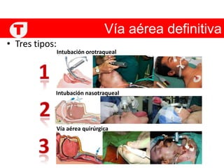 Vía aérea definitiva TTres tipos: Intubación orotraqueal1Intubación nasotraqueal2Vía aérea quirúrgica 3