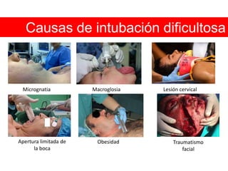 Clasificación de MallapantiGrado I: paladar blando + pilares + úvulaGrado II: paladar blando + pilares + base de úvulaGrado III: sólo se ve el paladar blando Grado IV: no se logra ver el paladar blando*	Grado I y II: predice intubación fácil	Grado III y IV: predice cierta dificultad para intubarClase 3Clase 1Clase 2Clase 4Fuente: Update in Anesthesia 1998; 9(9):1-4