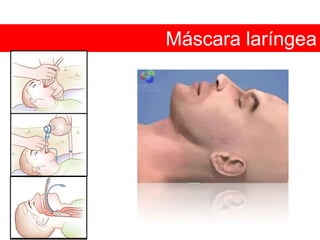Clasificación de Mallapanti