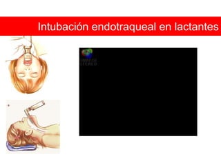 Distancia TiromentonianaGrado I:     > 6.5cmGrado II:   6.0 – 6.5cmGrado III:  < 6.0cm*	Grado I: Laringoscopia e intubación endotraqueal sin dificultad.	Grado II: Laringoscopia e intubación endotraqueal con cierta dificultad.	Grado III: Intubación endotraqueal muy difícil o imposible. Fuente: Update in Anesthesia 1998; 9(9):1-4