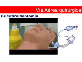 Intubación endotraqueal en lactantes