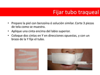 Secuencia de intubación rápida Esté preparado para hacer una VAQ en la eventualidad de que se pierda el control de la vía aéreaComprueba que la aspiración y el suministro de O2 estén listos para funcionar.Preoxigene al pcte. con O2 al 100%Aplique presión sobre el cartílago cricoides Administre un medicamento inductor o sedanteAdministre 1-2 mg/kg de succinilcolina IV.Luego que el pctesehaya relajado intube por VOT.Infle en balón y compruebe la posición correcta del tubo. Retire la presión sobre el cricoides.Ventile al pcte. SIR