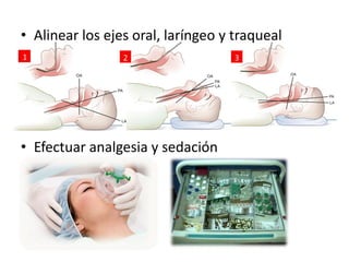 Alinear los ejes oral, laríngeo y traquealEfectuar analgesia y sedación  