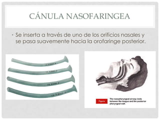 CÁNULA NASOFARINGEA
• Se inserta a través de uno de los orificios nasales y
se pasa suavemente hacia la orofaringe posterior.
 