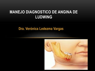 Dra. Verónica Ledezma Vargas
MANEJO DIAGNOSTICO DE ANGINA DE
LUDWING
 