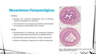 Necrosis
eosinofílica,
edema y
congestión
hemorrágica.
Isquemia
secundaria a
trombosis
Molde
esofágico de
secreciones y
cé...