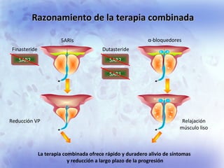 Razonamiento de la terapia combinadaRazonamiento de la terapia combinada
5AR2
5AR1
Finasteride Dutasteride
Reducción VP
5A...