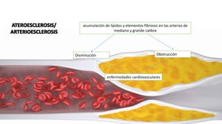 acumulación de lípidos y elementos fibrosos en las arterias de
mediano y grande calibre
enfermedades cardiovasculares
Disminución Obstrucción
 