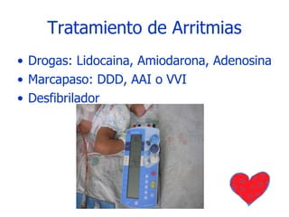 Tratamiento de Arritmias Drogas: Lidocaina, Amiodarona, Adenosina Marcapaso: DDD, AAI o VVI Desfibrilador 