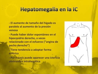 - El aumento de tamaño del hígado es
paralelo al aumento de la presión
venosa
- Puede haber dolor espontáneo en el
hipocondrio derecho, a veces
relacionado con el esfuerzo (“angina de
pecho derecho”)
- Tiene tendencia a adoptar forma
esférica
- Por estasis puede aparecer una ictericia
obstructiva intrahepática
 