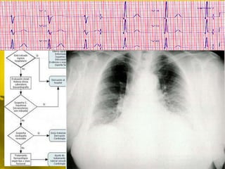  A. inicial: perfil cardiológico
 ECG




 Rx torax
 