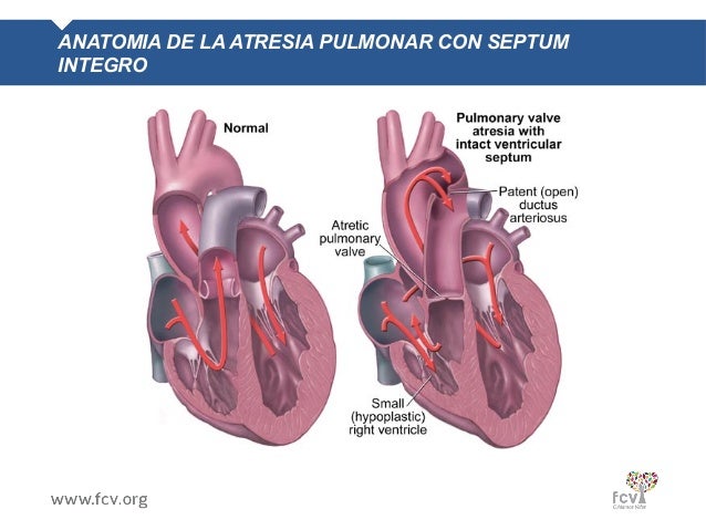 Manejo Quirurgico De La Atresia Pulmonar Con Septum Integro Manejo Quirurgico De La Atresia Pulmonar Con Septum Integro