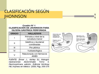 Johnson Classification System MANEJO QUIRURGICO DE LA ULCERA PEPTICA.ppt