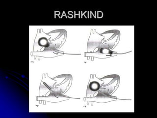 Conservative Rashkind Bas MANEJO SINDROMICO DE LA CARDIOPATIA CONGENITA terminado 1.pdf