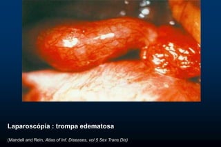 EMBARAZO ECTÓPICO
Laparoscópia : trompa edematosa
(Mandell and Rein, Atlas of Inf. Diseases, vol 5 Sex Trans Dis)
 