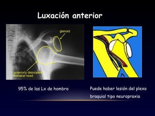 Luxación anterior
95% de las Lx de hombro Puede haber lesión del plexo
braquial tipo neuropraxia
 