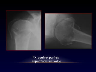 Fx cuatro partes
impactada en valgo
 