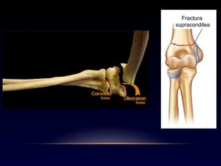 Fractura
supracondilea
 