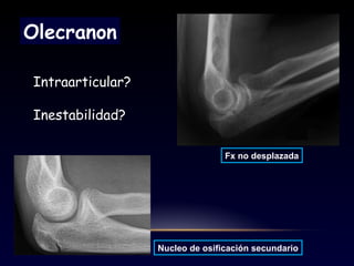 Olecranon
Intraarticular?
Inestabilidad?
Fx no desplazada
Nucleo de osificación secundario
 