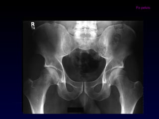 Fx pelvis
 