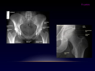 Fx pelvis
 
