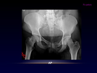 Fx pelvis
AP
 
