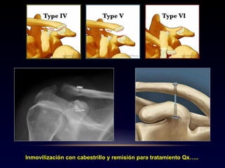Inmovilización con cabestrillo y remisión para tratamiento Qx…..
 