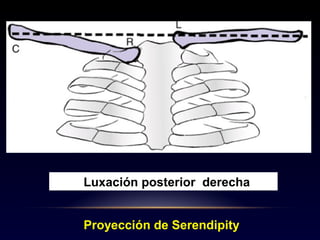Luxación posterior derecha
Proyección de Serendipity
 