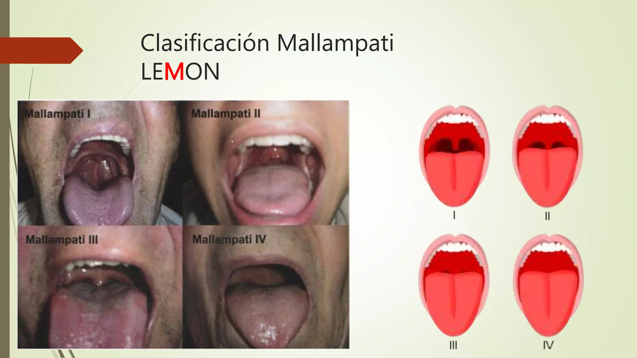Clasificación Mallampati
LEMON
 