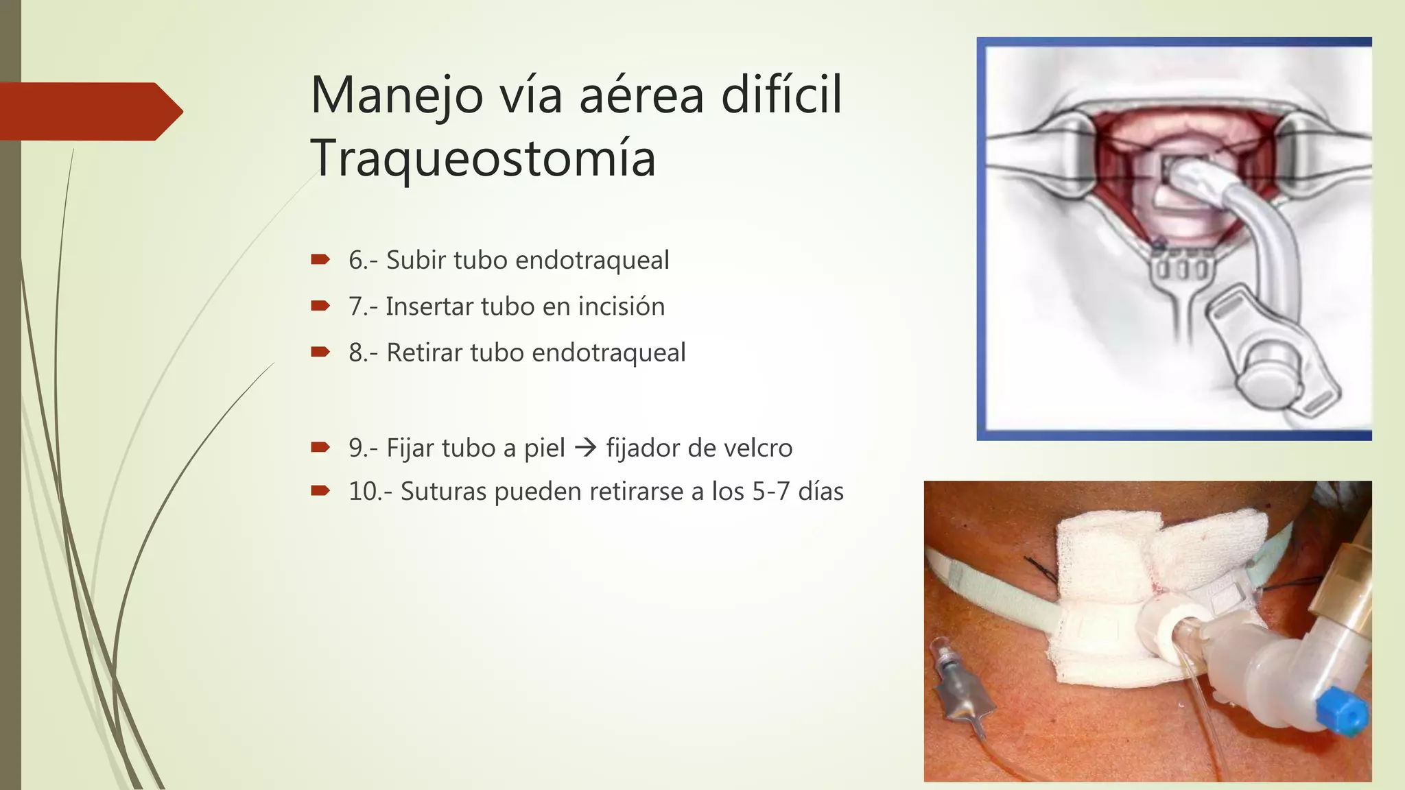 Manejo vía aérea difícil
Traqueostomía
 6.- Subir tubo endotraqueal
 7.- Insertar tubo en incisión
 8.- Retirar tubo endotraqueal
 9.- Fijar tubo a piel  fijador de velcro
 10.- Suturas pueden retirarse a los 5-7 días
 