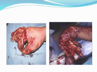 Mangled extremity and its Management | PPTX