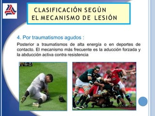 4. Por traumatismos agudos :
Posterior a traumatismos de alta energía o en deportes de
contacto. El mecanismo más frecuente es la aducción forzada y
la abducción activa contra resistencia
CLASIFICACIÓN SEG ÚN
EL M E C A N I S M O D E LESIÓN
 