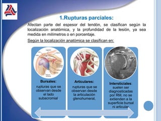 1.Rupturas parciales:
Afectan parte del espesor del tendón, se clasifican según la
localización anatómica, y la profundidad de la lesión, ya sea
medida en milímetros o en porcentaje.
Según la localización anatómica se clasifican en:
Bursales:
rupturas que se
observan desde
el lado
subacromial.
Articulares:
rupturas que se
observan desde
la articulación
glenohumeral,
Intersticiales:
suelen ser
diagnosticadas
por RM, no se
extienden a la
superficie bursal
ni articular.
 